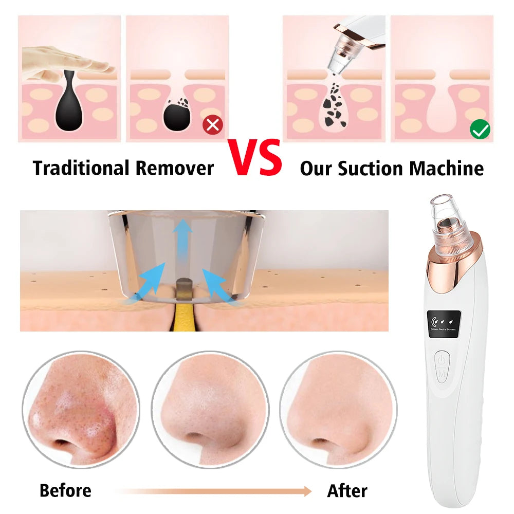 5-in-1 Rechargeable Blackhead Remover & Pore Cleaner Vacuum